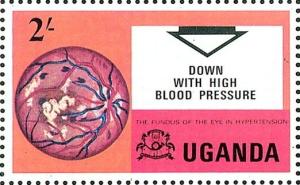 Colnect-1106-785-The-Fundus-of-the-Eye-in-Hypertension.jpg